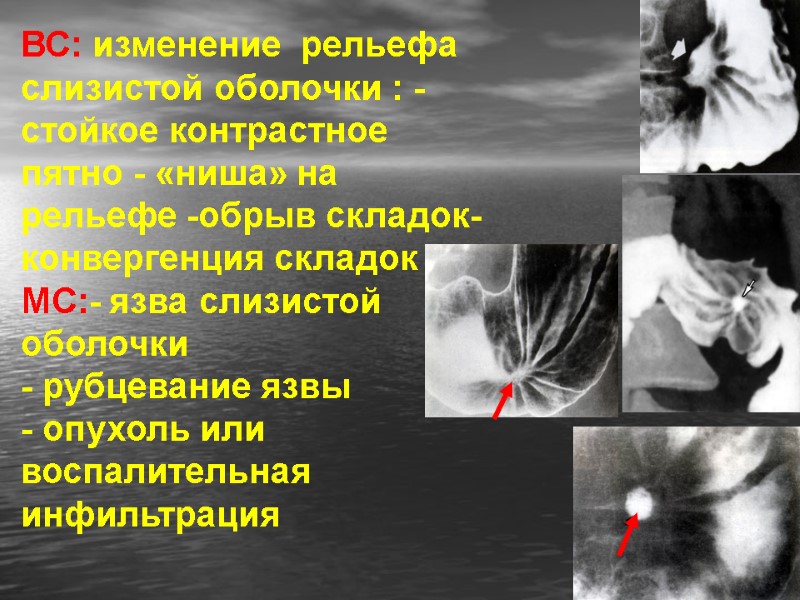 ВС: изменение  рельефа  слизистой оболочки : -стойкое контрастное пятно - «ниша» на